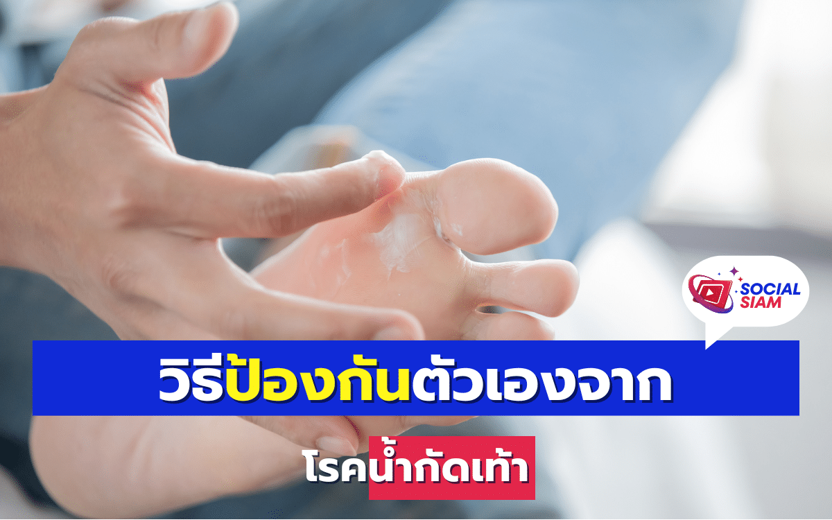 น้ำกัดเท้า เป็นภาวะที่ผิวหนังบริเวณเท้าเปื่อยลอก แดง แสบและคัน เนื่องจากต้องเดินย่ำน้ำบ่อย ๆ ทำให้ผิวหนังเกิดแผลได้ง่าย และอาจติดเชื้อราหรือเชื้อแบคทีเรียได้ วันนี้ SOCAILSIAM มีสาระความรู้ดีๆจะมาบอกใครยังอยากรู้วิธีรักษาตามมาเลย